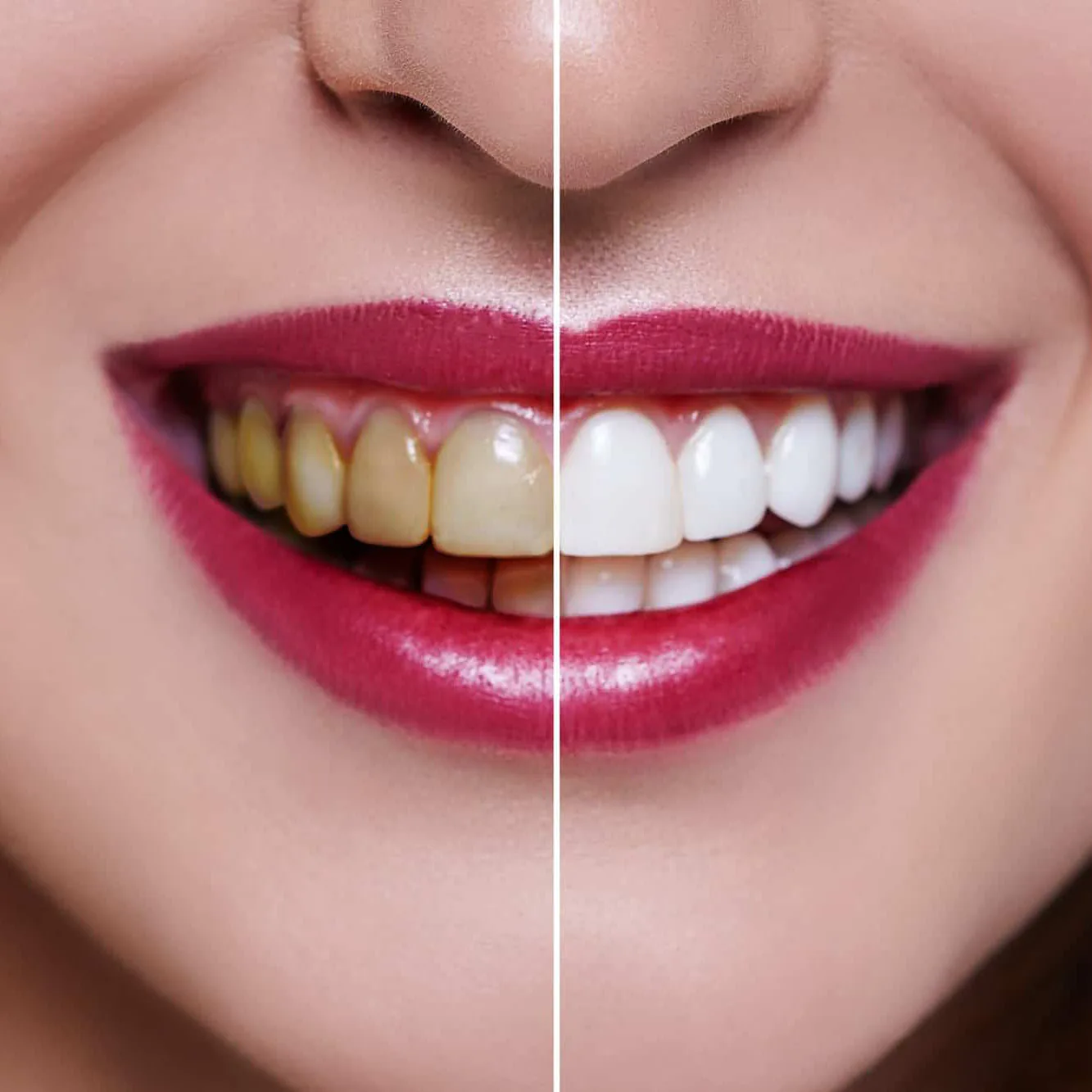 Professional Teeth Whitening - Korona Dental Belgrade