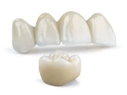 Metal-Free Ceramic Crowns & Bridges - Korona Dental Belgrade