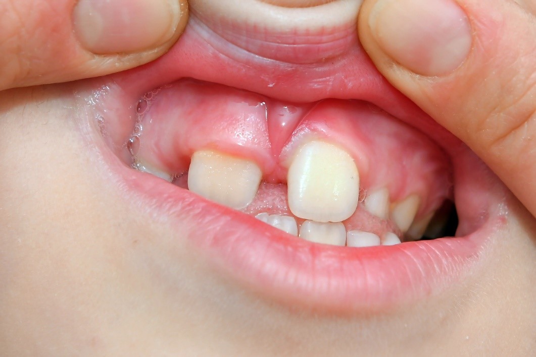 Pediatric & Preventive Dentistry - Korona Dental Belgrade
