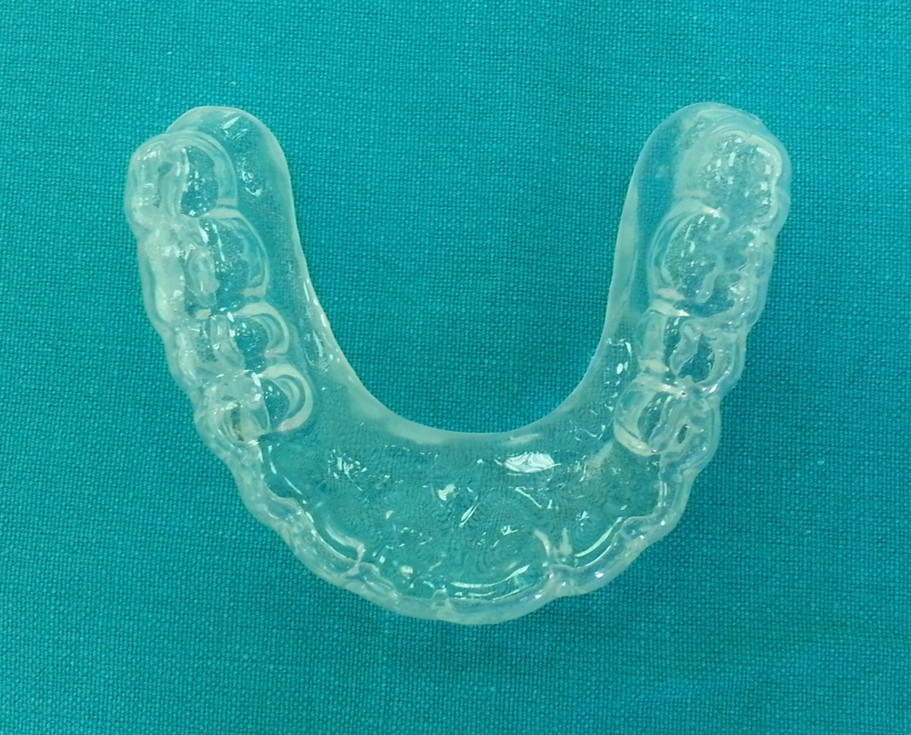 Dual-Laminate Custom Bruxism Guards - Korona Dental Belgrade