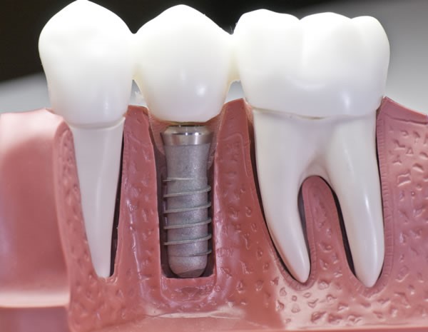 Premium Titanium & Ceramic Implants - Korona Dental Belgrade