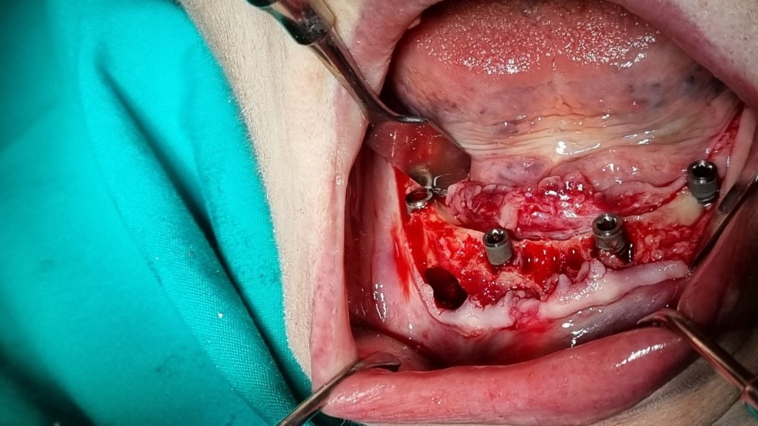 Implantology & Bone Augmentation - Korona Dental Belgrade