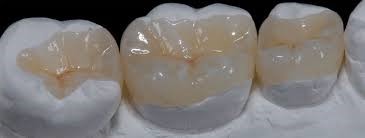 Ceramic Inlays, Onlays & Overlays - Korona Dental Belgrade