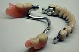 Precision Attachment Combined Dentures - Korona Dental Belgrade