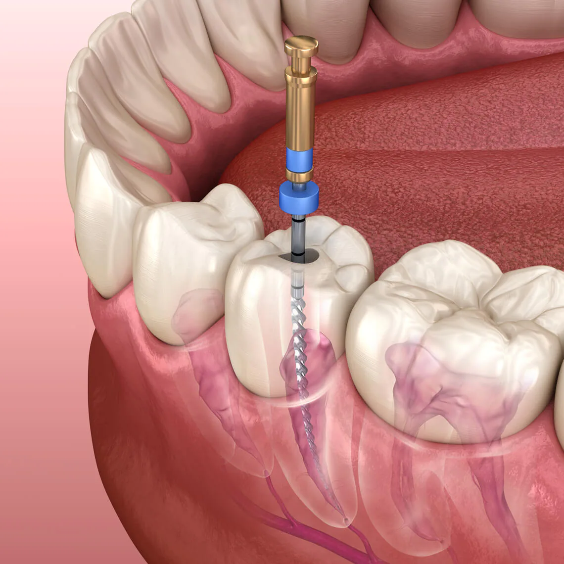 Cavity Treatment & Endodontics - Korona Dental Belgrade