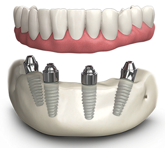 All-on-4 & All-on-6 Fixed Arch Concept - Korona Dental Belgrade