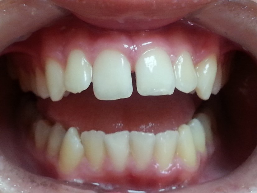 Orthodontics (Bite Correction) - Korona Dental Belgrade