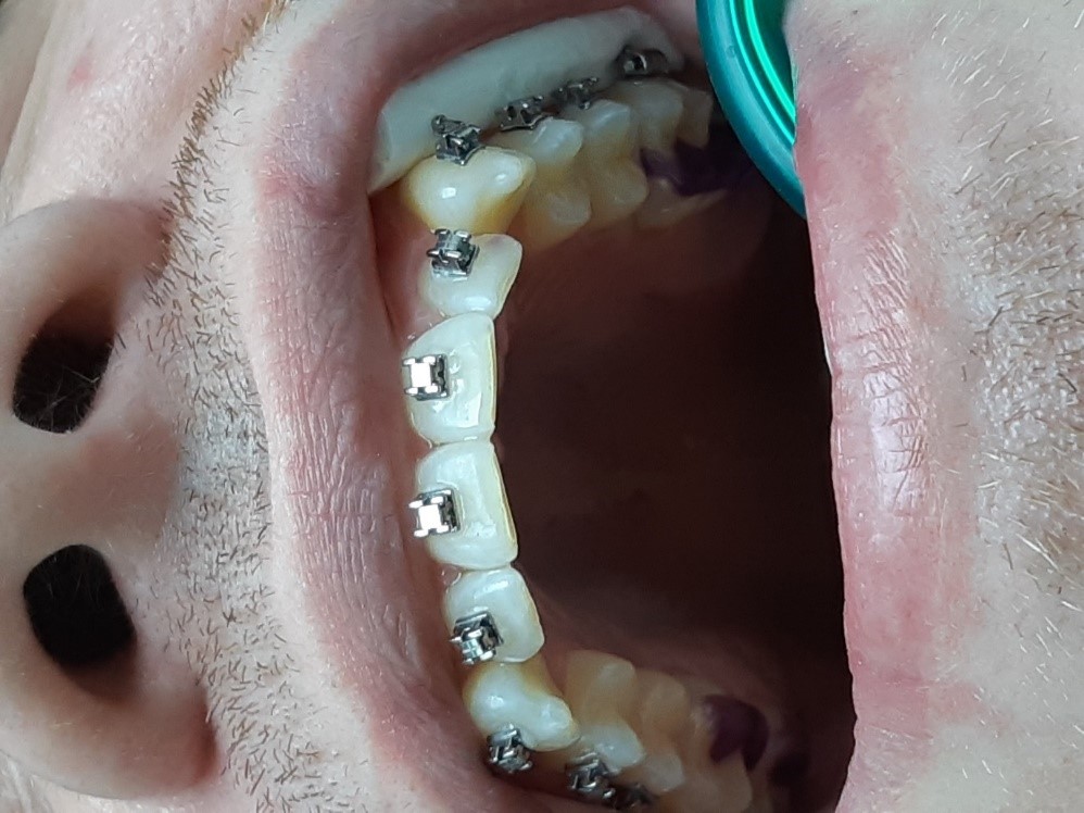 Early Interceptive Removable Appliances - Korona Dental Belgrade
