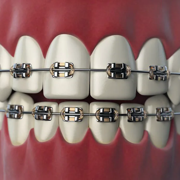 Clear Removable Aligners (Invisible Braces) - Korona Dental Belgrade