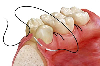 Periodontal Surgery & Gum Care - Korona Dental Belgrade
