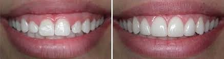 Deep Pocket Curettage & Laser Decontamination - Korona Dental Belgrade