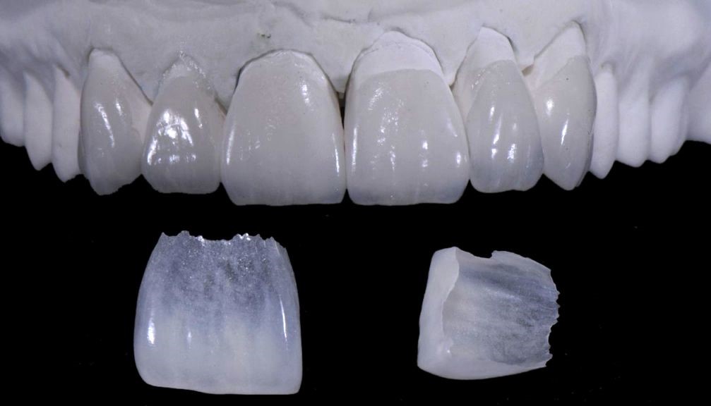 Dental Prosthetics & Smile Restoration - Korona Dental Belgrade