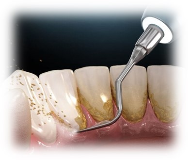 Ultrasonic Calculus & Tartar Removal - Korona Dental Belgrade
