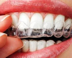TMJ Jaw Joint Decompression - Korona Dental Belgrade