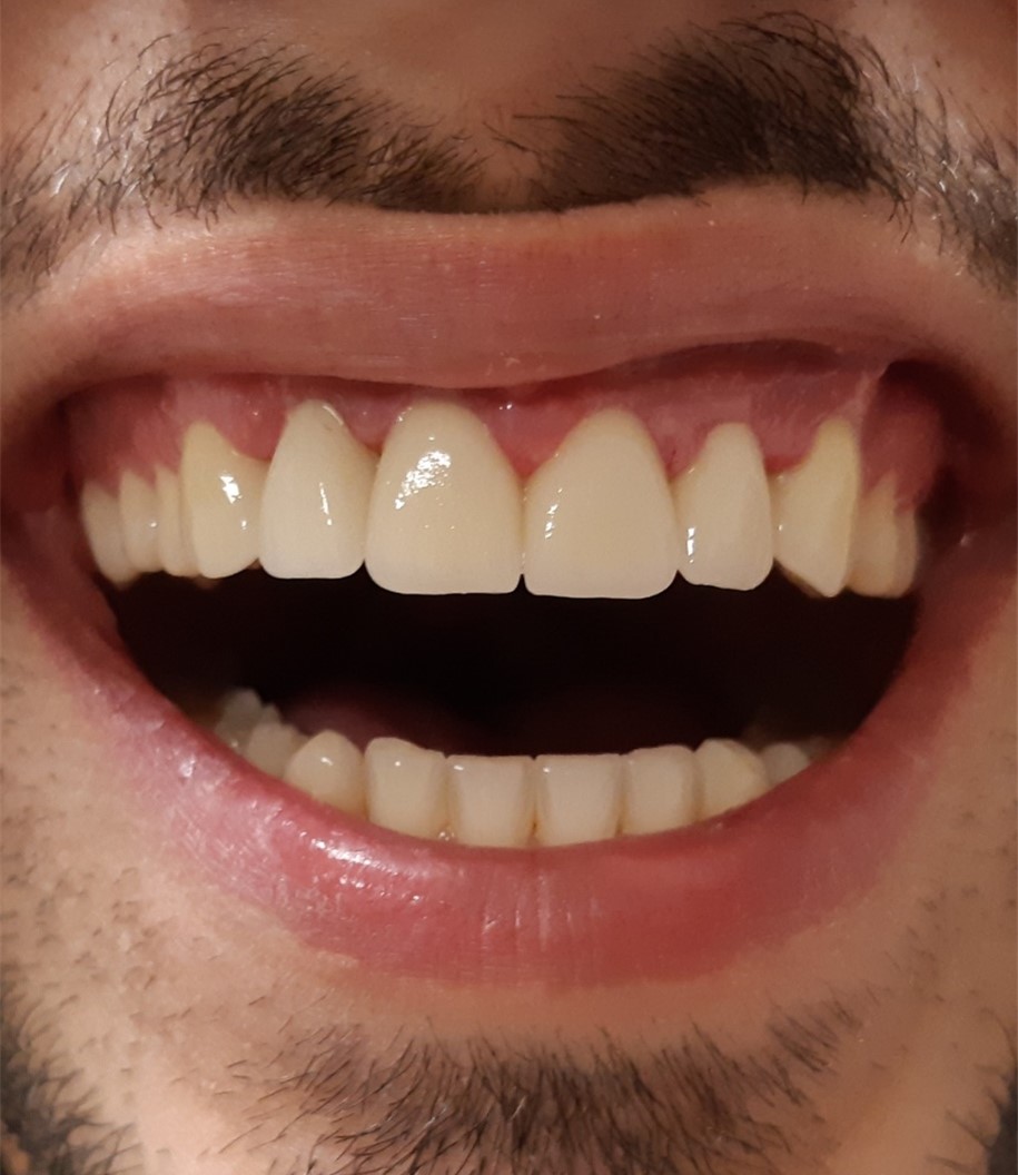 Zirconia & Hollywood Smile - Korona Dental Belgrade