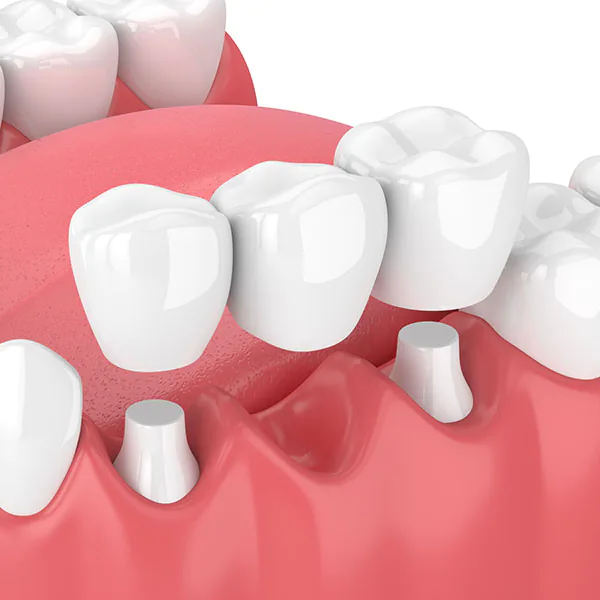 Full Anatomic Monolithic Zirconia - Korona Dental Belgrade