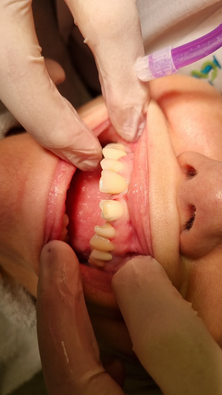 Long-Span Zirconia Bridge Frameworks - Korona Dental Belgrade